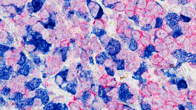 What Are the Next Breakthroughs in Cancer Research and Care?