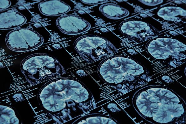 Milken Institute projects doubling of Americans living with dementia