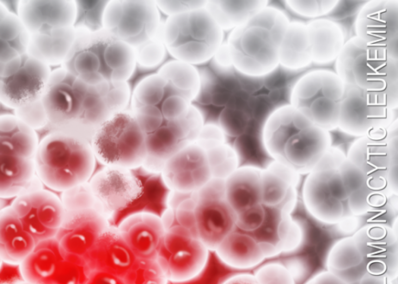 Chronic Myelomonocytic Leukemia - A Giving Smarter Guide
